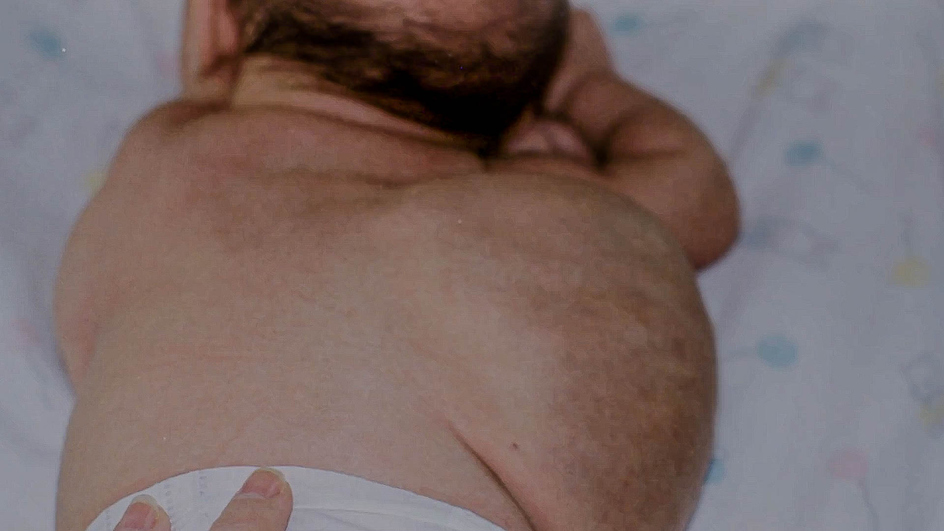 Living with Proteus syndrome meant constant challenges
