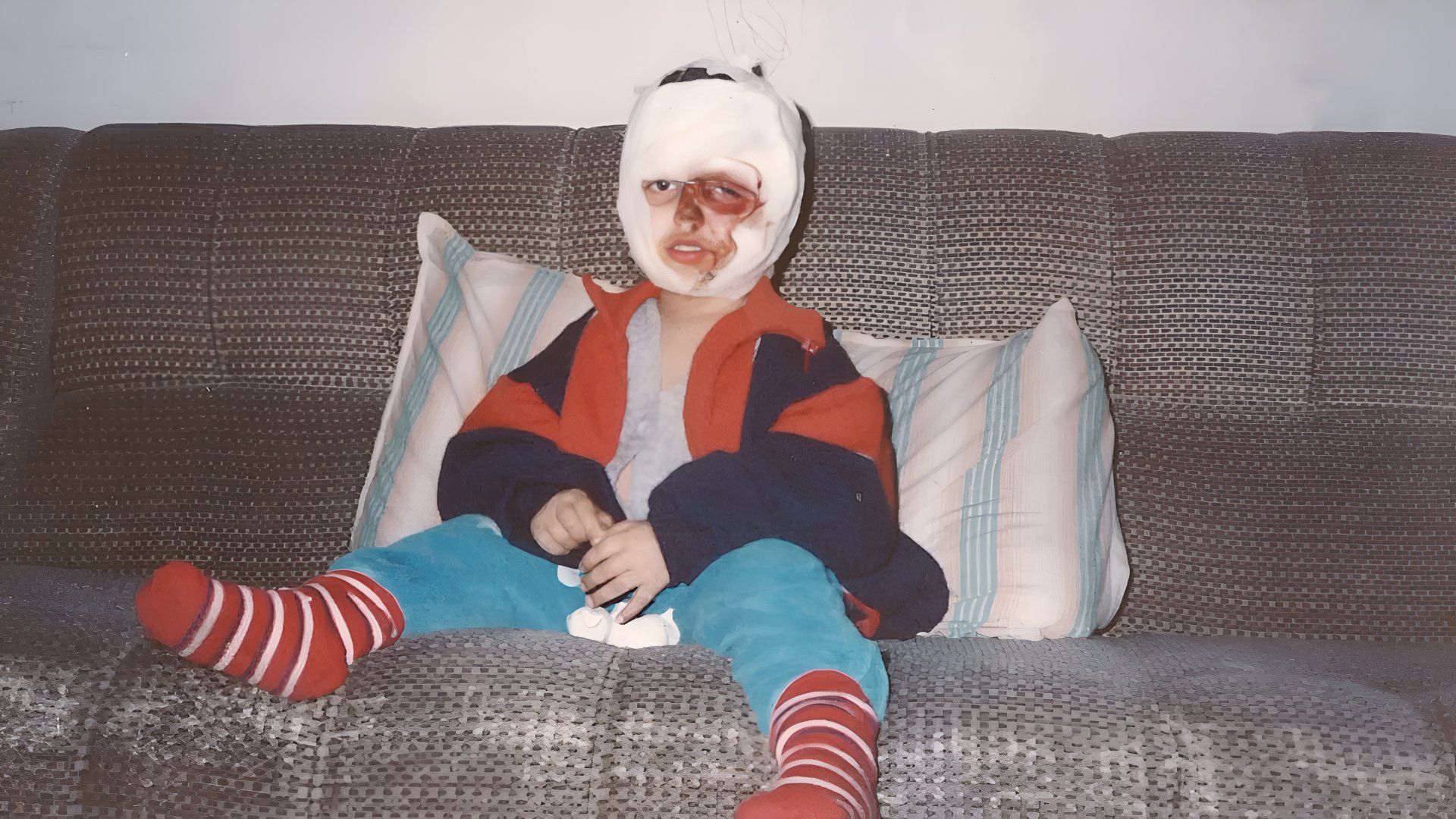 At just two years old, a kitchen accident caused third-degree burns.
